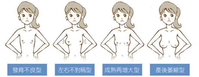 自體脂肪隆乳價錢,自體脂肪隆乳ptt,自體脂肪隆乳費用,自體脂肪隆乳缺點, 自體脂肪隆乳Dcard,自體脂肪隆乳術後,自體脂肪隆乳失敗,自體脂肪隆乳手術術後恢復期心得日記自體脂肪隆乳經驗分享 台灣自體脂肪隆乳達人鍾金源