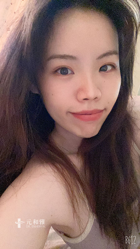 結構式自體肋骨隆鼻失敗,結構式自體肋骨隆鼻分期,結構式自體肋骨隆鼻手術費用,結構式自體肋骨隆鼻手術推薦,結構式自體肋骨隆鼻手術後遺症,結構式自體肋骨隆鼻手術疤痕,結構式自體肋骨隆鼻手術費用ptt,結構式自體肋骨隆鼻價錢 結構式自體肋骨隆鼻失敗,結構式自體肋骨隆鼻分期,結構式自體肋骨隆鼻手術費用,結構式自體肋骨隆鼻手術推薦,結構式自體肋骨隆鼻手術後遺症,結構式自體肋骨隆鼻手術疤痕,結構式自體肋骨隆鼻手術費用ptt,結構式自體肋骨隆鼻價錢