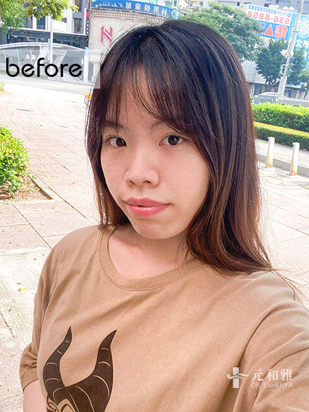 結構式自體肋骨隆鼻失敗,結構式自體肋骨隆鼻分期,結構式自體肋骨隆鼻手術費用,結構式自體肋骨隆鼻手術推薦,結構式自體肋骨隆鼻手術後遺症,結構式自體肋骨隆鼻手術疤痕,結構式自體肋骨隆鼻手術費用ptt,結構式自體肋骨隆鼻價錢 結構式自體肋骨隆鼻失敗,結構式自體肋骨隆鼻分期,結構式自體肋骨隆鼻手術費用,結構式自體肋骨隆鼻手術推薦,結構式自體肋骨隆鼻手術後遺症,結構式自體肋骨隆鼻手術疤痕,結構式自體肋骨隆鼻手術費用ptt,結構式自體肋骨隆鼻價錢
