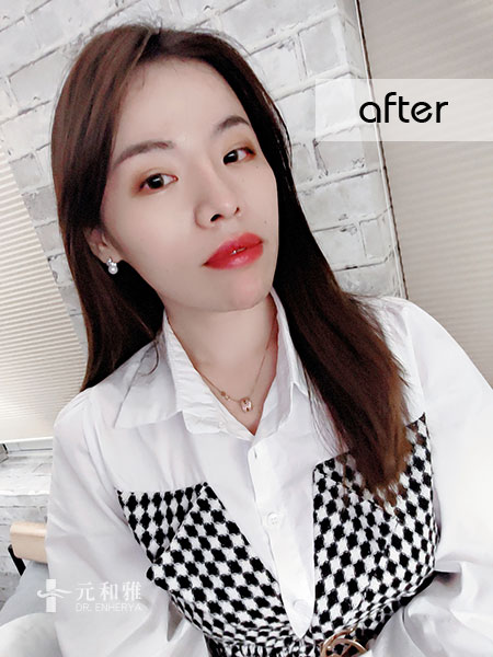 結構式自體肋骨隆鼻失敗,結構式自體肋骨隆鼻分期,結構式自體肋骨隆鼻手術費用,結構式自體肋骨隆鼻手術推薦,結構式自體肋骨隆鼻手術後遺症,結構式自體肋骨隆鼻手術疤痕,結構式自體肋骨隆鼻手術費用ptt,結構式自體肋骨隆鼻價錢 結構式自體肋骨隆鼻失敗,結構式自體肋骨隆鼻分期,結構式自體肋骨隆鼻手術費用,結構式自體肋骨隆鼻手術推薦,結構式自體肋骨隆鼻手術後遺症,結構式自體肋骨隆鼻手術疤痕,結構式自體肋骨隆鼻手術費用ptt,結構式自體肋骨隆鼻價錢