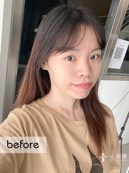 結構式自體肋骨隆鼻失敗,結構式自體肋骨隆鼻分期,結構式自體肋骨隆鼻手術費用,結構式自體肋骨隆鼻手術推薦,結構式自體肋骨隆鼻手術後遺症,結構式自體肋骨隆鼻手術疤痕,結構式自體肋骨隆鼻手術費用ptt,結構式自體肋骨隆鼻價錢 結構式自體肋骨隆鼻失敗,結構式自體肋骨隆鼻分期,結構式自體肋骨隆鼻手術費用,結構式自體肋骨隆鼻手術推薦,結構式自體肋骨隆鼻手術後遺症,結構式自體肋骨隆鼻手術疤痕,結構式自體肋骨隆鼻手術費用ptt,結構式自體肋骨隆鼻價錢