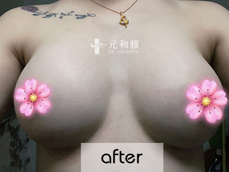 魔滴隆乳價錢,魔滴隆乳ptt,魔滴隆乳費用,魔滴隆乳缺點,魔滴Dcard,魔滴隆乳術後,魔滴隆乳失敗,魔滴隆乳手術術後恢復期心得日記魔滴隆乳經驗分享 ,魔滴隆乳費用價格,魔滴隆乳推薦,魔滴隆乳 魔滴隆乳價錢,魔滴隆乳ptt,魔滴隆乳費用,魔滴隆乳缺點,魔滴Dcard,魔滴隆乳術後,魔滴隆乳失敗,魔滴隆乳手術術後恢復期心得日記魔滴隆乳經驗分享 ,魔滴隆乳費用價格,魔滴隆乳推薦,魔滴隆乳