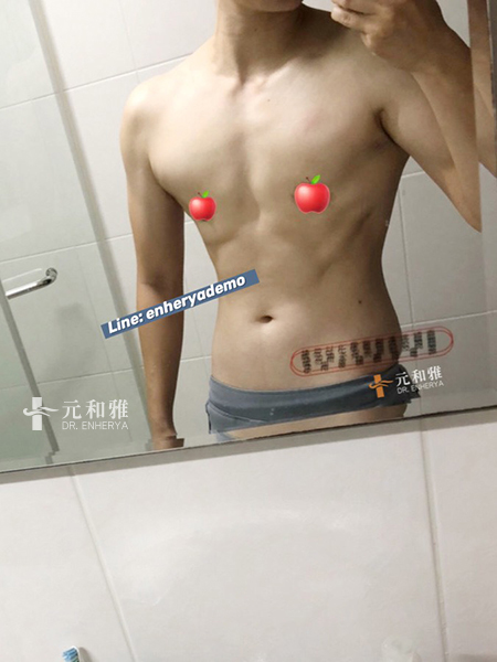 平胸價錢,平胸ptt,平胸費用,平胸缺點, 平胸Dcard,平胸術後,平胸失敗,平胸手術術後恢復期心得日記平胸經驗分享,平胸費用,平胸手術,平胸後悔,平胸失敗,平胸案例,平胸Dcard,平胸材質,平胸價格,2023平胸懶人包,平胸方式比較,平胸手術切口,平胸適合對象,平胸手術醫師選擇 平胸價錢,平胸ptt,平胸費用,平胸缺點, 平胸Dcard,平胸術後,平胸失敗,平胸手術術後恢復期心得日記平胸經驗分享,平胸費用,平胸手術,平胸後悔,平胸失敗,平胸案例,平胸Dcard,平胸材質,平胸價格,2023平胸懶人包,平胸方式比較,平胸手術切口,平胸適合對象,平胸手術醫師選擇