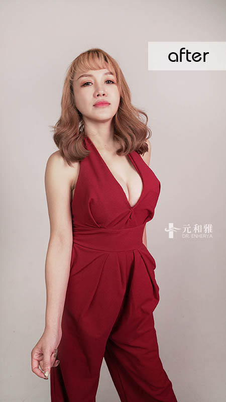 女王波隆乳價錢,女王波隆乳ptt,女王波隆乳費用,女王波隆乳缺點, 女王波隆乳Dcard,女王波隆乳術後,女王波隆乳失敗,女王波隆乳手術術後恢復期心得日記女王波隆乳經驗分享,女王波隆乳費用,女王波隆乳手術,女王波隆乳後悔,女王波隆乳失敗,女王波隆乳案例,女王波隆乳Dcard,女王波隆乳材質,女王波隆乳價格,2022女王波隆乳懶人包,女王波隆乳方式比較,女王波隆乳手術切口,女王波隆乳適合對象,女王波隆乳手術醫師選擇