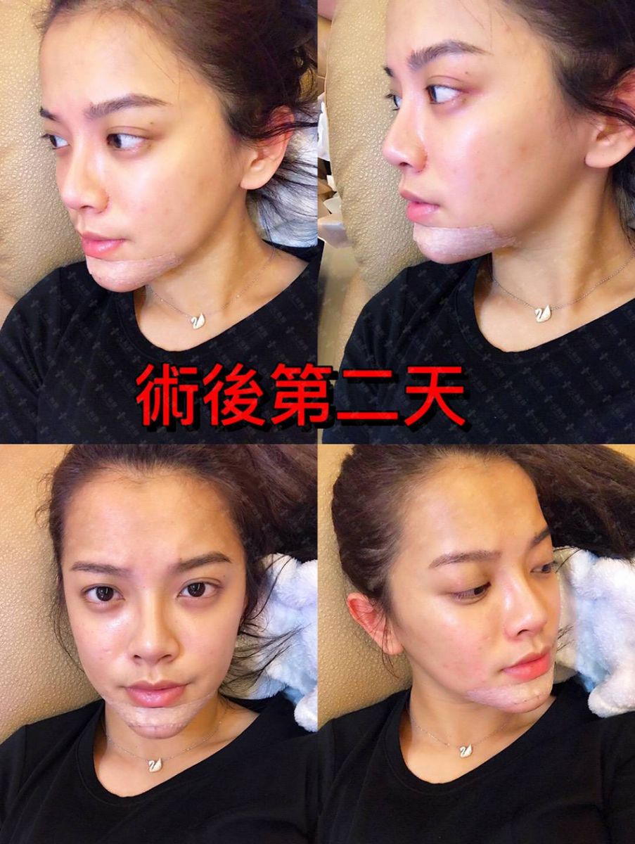 下巴整形失敗後遺症 墊下巴重修的常見原因 璞美整形外科醫美診所
