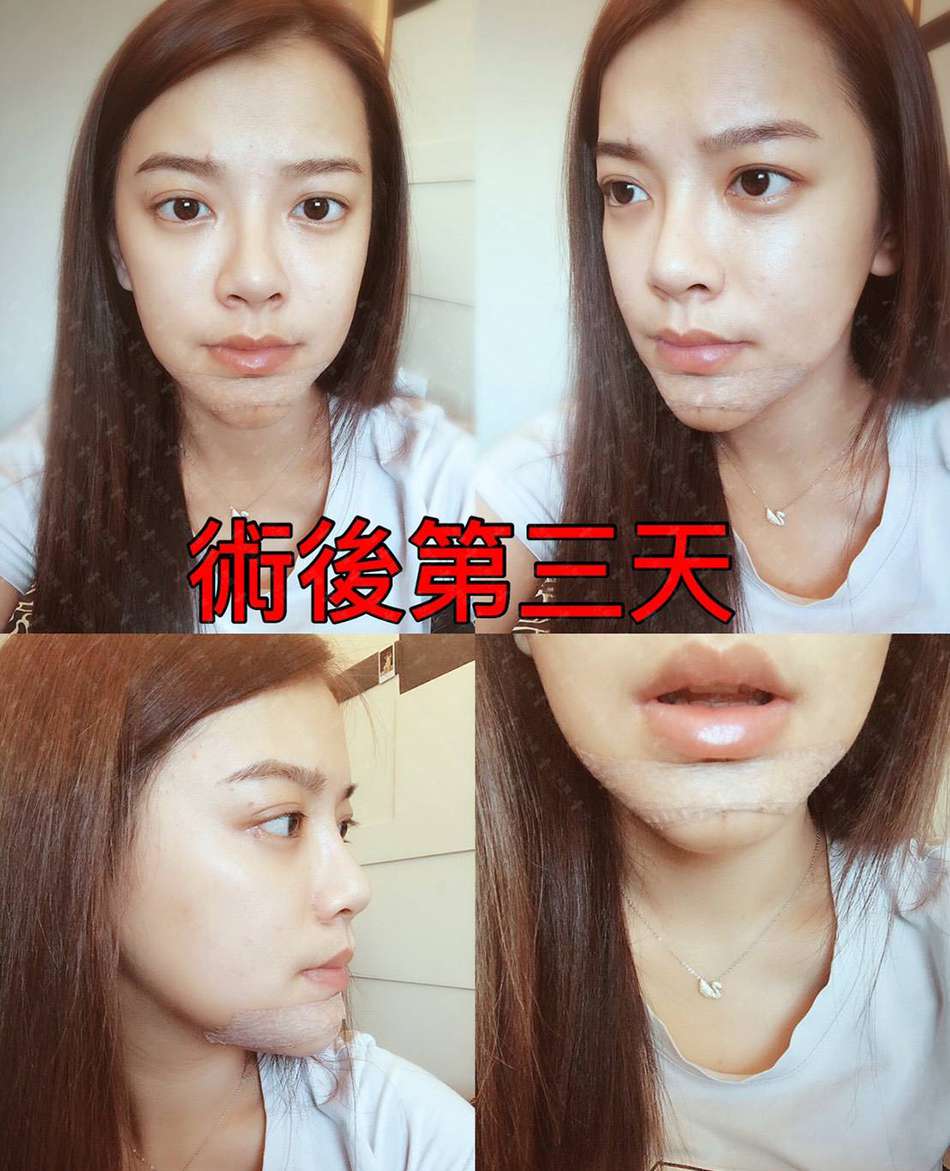 墊下巴手術 自然升級瓜子臉正妹 下巴精雕心機耍萌 客製化下巴手術 下巴手術 整形外科 魔滴隆乳 隆乳 自體脂肪隆乳 隆鼻 複合式抽脂 平胸 拉皮 肌力塑 元和雅整形外科診所
