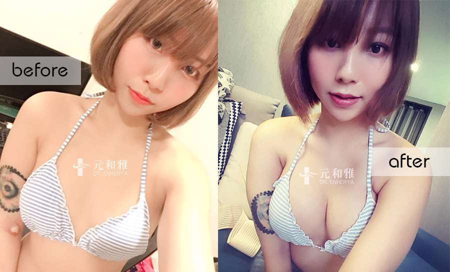 Motiva魔滴隆乳手術全紀錄辣模星諠， Dcard推薦隆乳專家