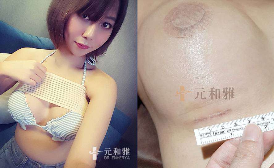 2024Motiva魔滴隆乳價格motiva十萬妳敢做？ 害怕魔滴失敗黑心隆乳慘成石頭奶，台北台南高雄魔滴推薦