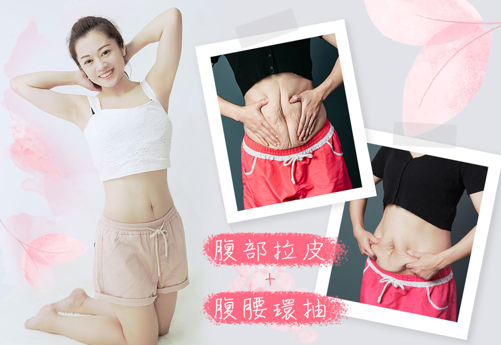 腹部拉皮腹腰環抽三寶媽重返產前好身材，台北台南高雄腹部拉皮推薦！